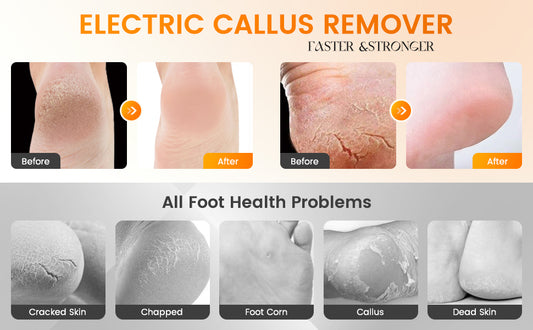 Electric Callus Remover Foot File – Get Salon-Soft Feet at Home in 60 Seconds