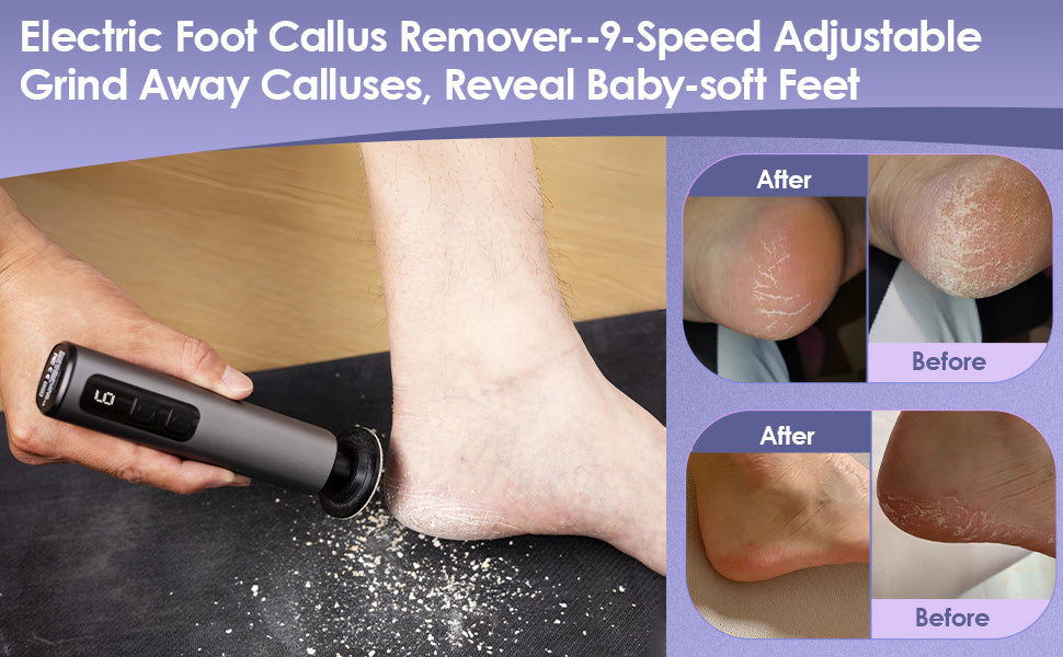 Electric Callus Remover Foot File – Get Salon-Soft Feet at Home in 60 Seconds
