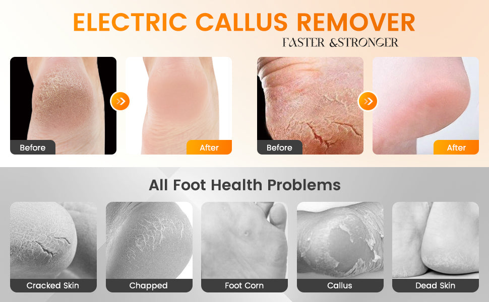 Electric Callus Remover Foot File – Get Salon-Soft Feet at Home in 60 Seconds